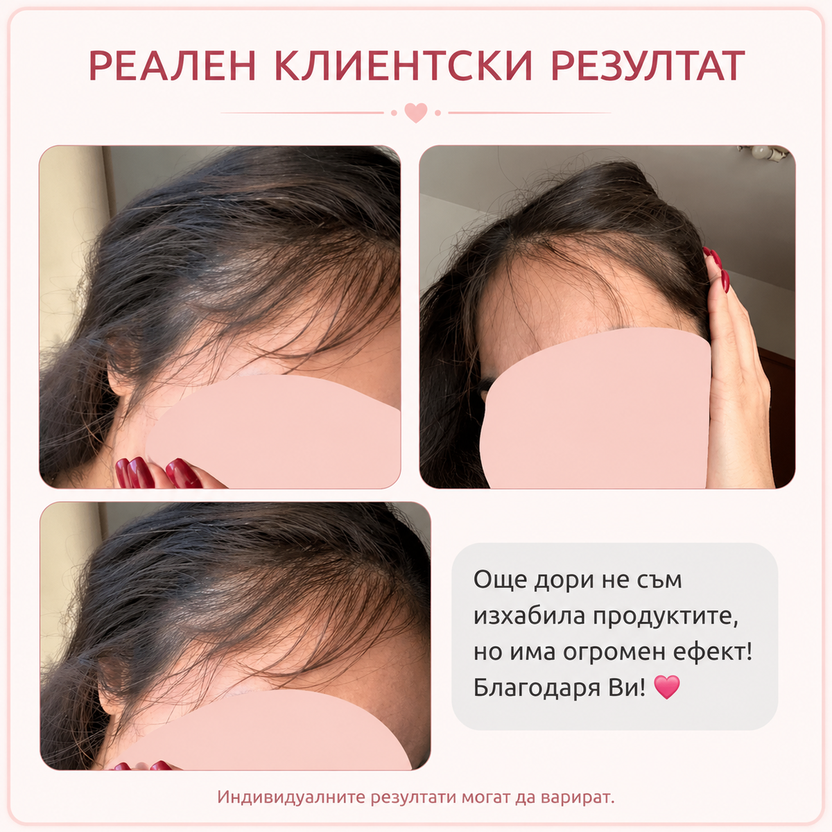     Резултат след употреба на комплект за растеж на косата – реален клиентски резултат